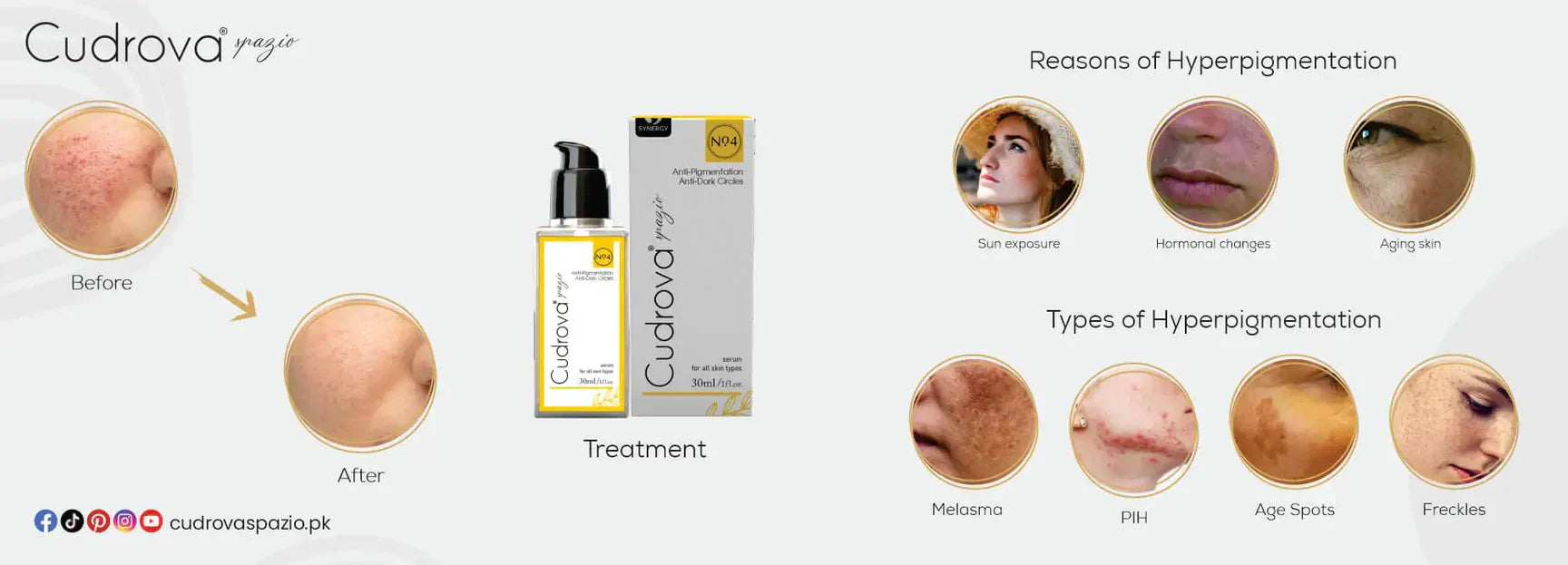 What is Hyperpigmentation? Causes and Effective Treatments for Clear Skin in 2024